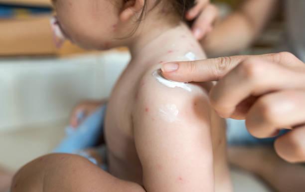 Expert Advice on chickenpox – a rite of passage or should you vaccinate?