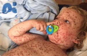 Turned away by a GP, this toddler spent DAYS in hospital with horrific chickenpox
