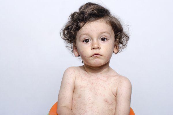 Measles cases highest in 20 years as anti-vaccine movement grows