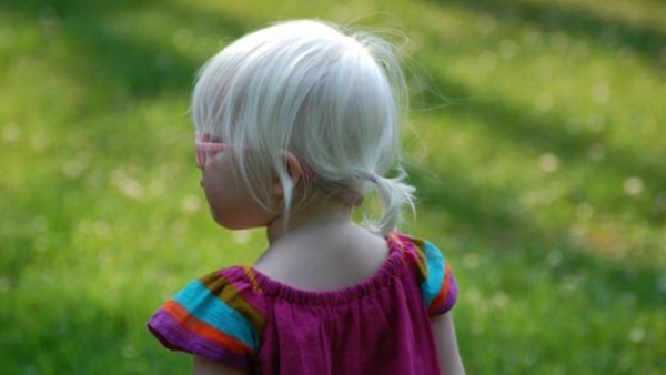 How Disney S Frozen Gave A Little Girl With Albinism A